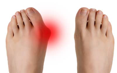 Need Bunion Surgery? Dr. Mark Fillari is Here for You!