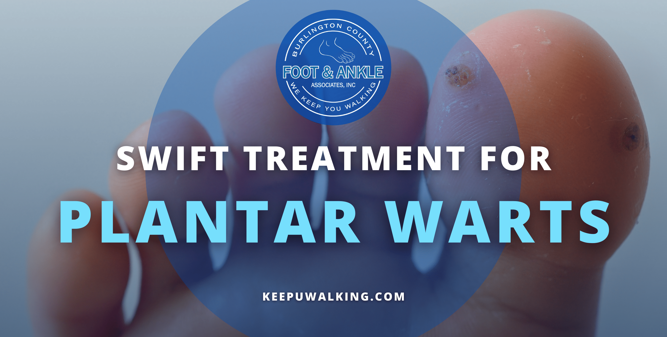 Swift Treatment for Plantar Warts