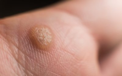Breaking Down the Different Treatment Options for Plantar Warts