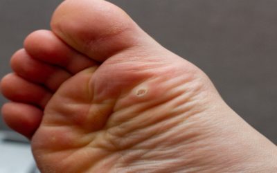 How to Put Plantar Warts in Your Past [and Keep them Out of Your Future]