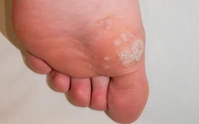 Worry Warts: Some Wart Myths – and What DOES Work for Plantar Warts