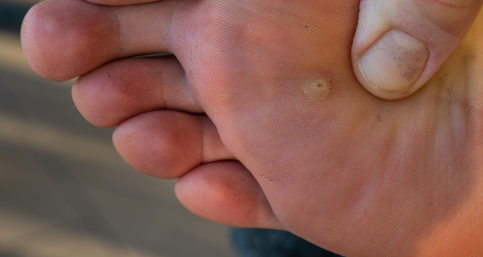 a foot with a plantar wart