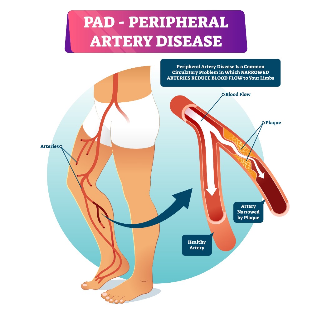 Peripheral Artery Disease (PAD) explained