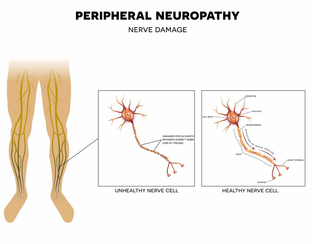Peripheral neuropathy explained