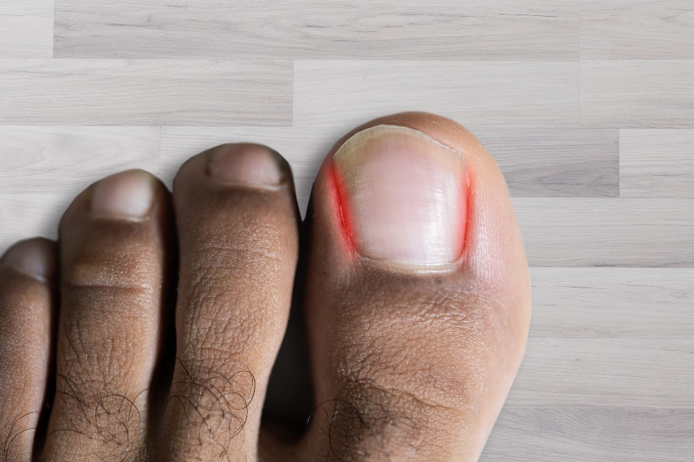 Foot with ingrown toenail on big toe